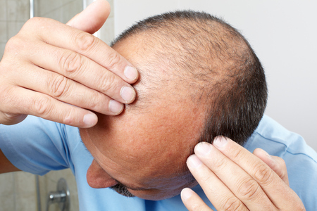 アスク井上クリニックとアイランドタワークリニックで頭頂部の植毛を検討する男性